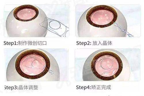 三、嘉兴爱尔眼科医院全飞秒怎么预约？价格多少？yanke.yadoo.cn