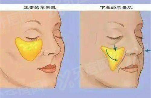 祝东升医生做面部拉皮多少钱？轻度5k/中度8.5/重度1.2W元起