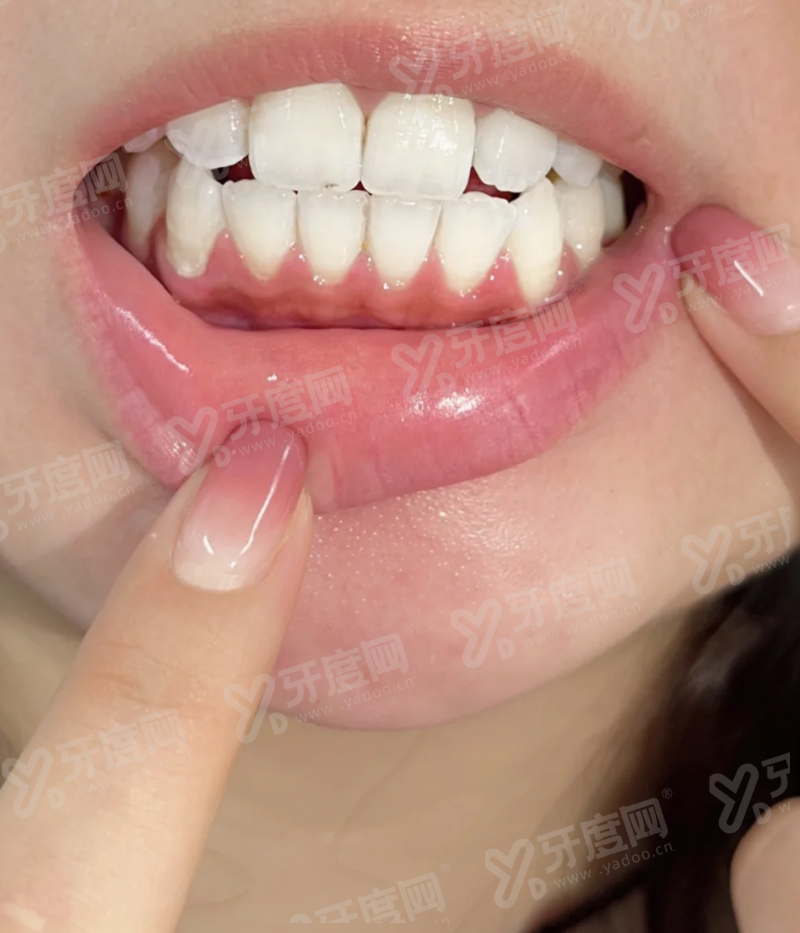 二、士卓曼种植牙价格表（不同档次价格不同，以下为参考价格）yanke.yadoo.cn