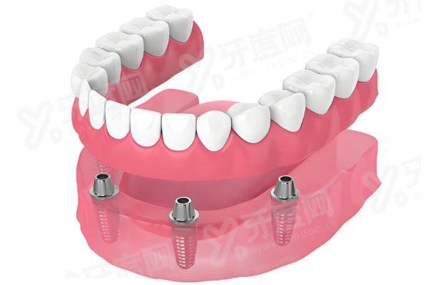 All-on-4 全口种植牙一日重建靠谱吗？百万案例验证！全口缺失/骨量不足者优选，咀嚼功能媲美真牙