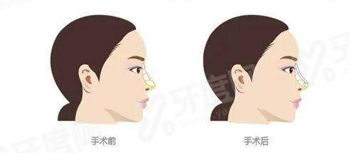 二、植发后能维持几年yanke.yadoo.cn