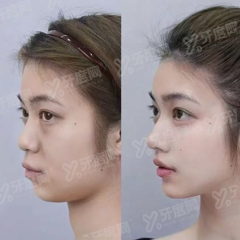 植发2000毛囊要多少钱？FUT有痕8k/FUE无痕1w元起