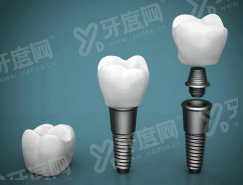 老人活动假牙支架用钴铬还是纯钛好？纯钛舒适耐用钴铬价格更便宜