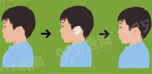 黄大勇在哪家医院北京多少钱？口内入路截骨术3W+/下颌角修整术单侧2.8W+