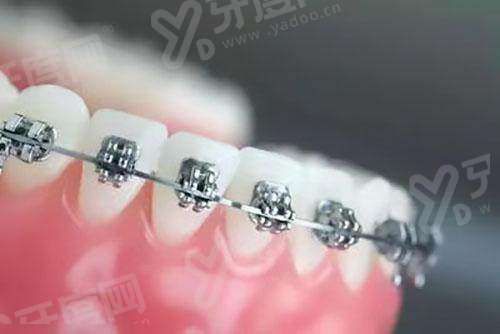 自锁托槽矫正和金属托槽矫正的区别：从设计/舒适度/矫正效率/价格看哪个好