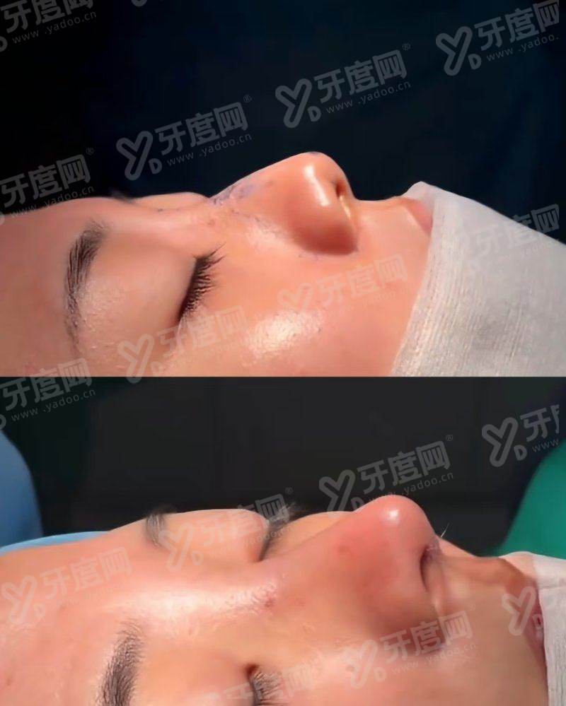 二、内膜修复治疗是怎么样yanke.yadoo.cn