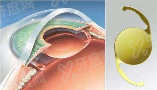  二、刘保松骨干医生的坐诊地点及时间？（郑州/驻马店尖峰眼科坐诊，时间详询）yanke.yadoo.cn