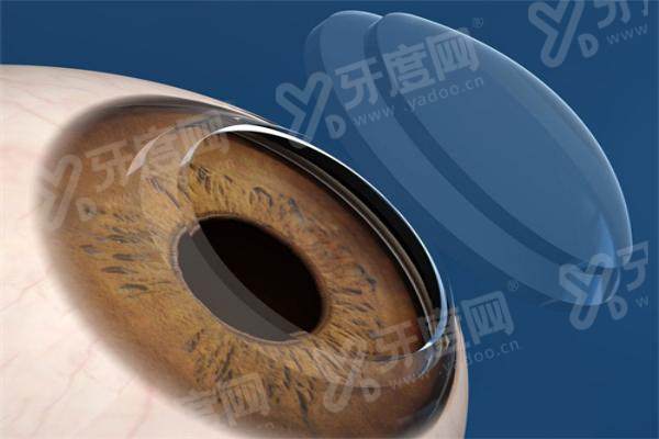 大坪医院近视手术优惠政策：医保报销、各类补贴等！叶剑擅ICL、刘明明精全飞秒等很靠谱！