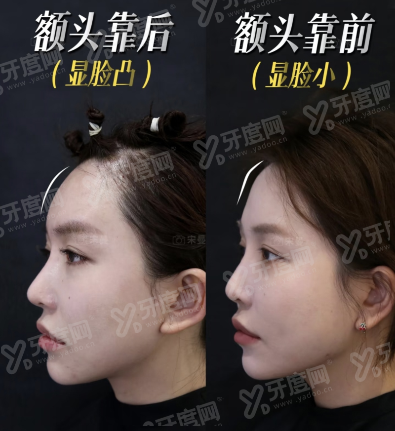 北京王恒医生修复双眼皮多少钱？基础4k/二级修复4.4W/三级修复4.8W