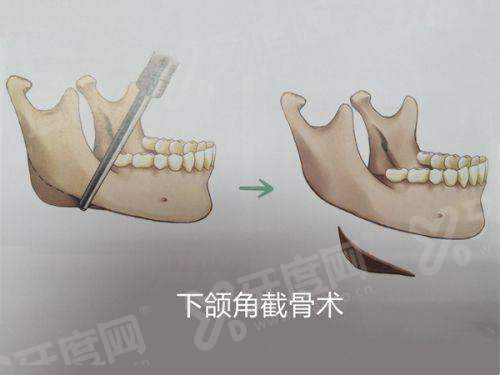 普丽妍童颜针多少钱一只？1万元起，揭秘其作用和成效