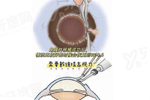 东莞爱尔眼科医院近视手术靠谱吗？当然靠谱，附预约挂号攻略！