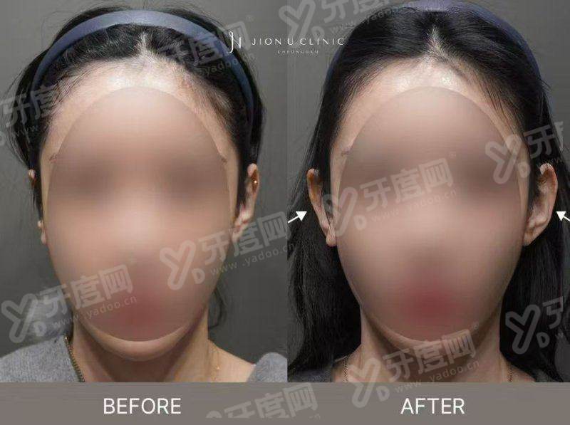 上海杨建国注射鼻基底怎么样？亲测效果超自然，价格表透明合理，附超详细预约挂号攻略！