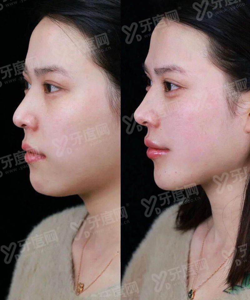 王春虎医生苹果肌提升多少钱？5000元起，苹果肌提升技术娴熟！