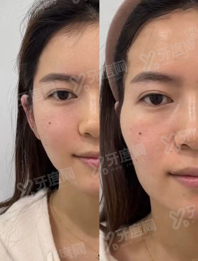 二、上海整形医生赵鹏技术怎么样？yanke.yadoo.cn