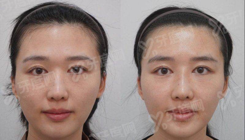 珠海狐臭手术费用多少钱？传统手术3k/微创4k元起