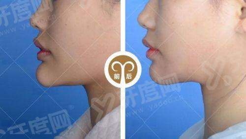 董瑞芳医生眼修复厉害吗？超厉害！董瑞芳做双眼皮价格表公开，她是郑州郑美医疗美容整形大咖！