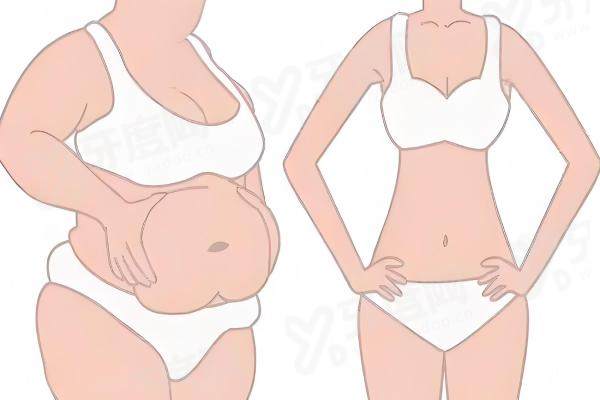 南京艺星做吸脂怎么样？南京艺星吸脂医生推荐陈孝闯，10余年9000台无事故手术