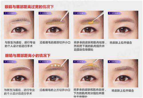 郭江花是哪个医院的院长？杭州美莱，技术娴熟教你怎么预约！