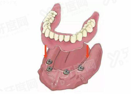 半口牙种植几颗好牙能保留吗？符合条件能保留-还能减创伤提稳定！4颗or6颗方案揭秘 