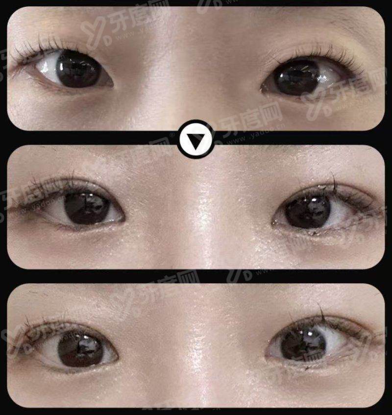 腋臭手术做清新微波多少钱？3000元起，做清新微波有用！