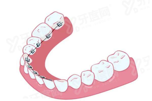 舌侧隐形矫正器有哪些品牌？瑞通eBrace、3M Incognito等可选，超10万病例验证舌侧隐形矫正效果精准又护齿