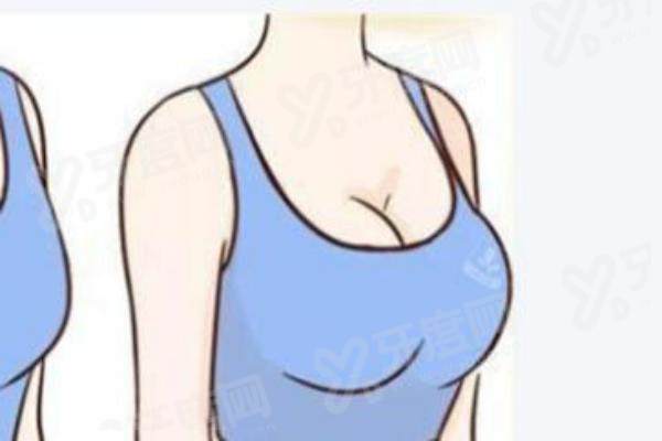 武汉艺星整形医院隆胸和拉皮哪个做的好？按需选择更合适，拉皮2万起隆胸3万起