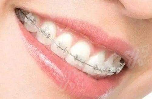 二、瑞典诺贝尔active与金致价格表？（单颗/基台/牙冠全包含）yanke.yadoo.cn