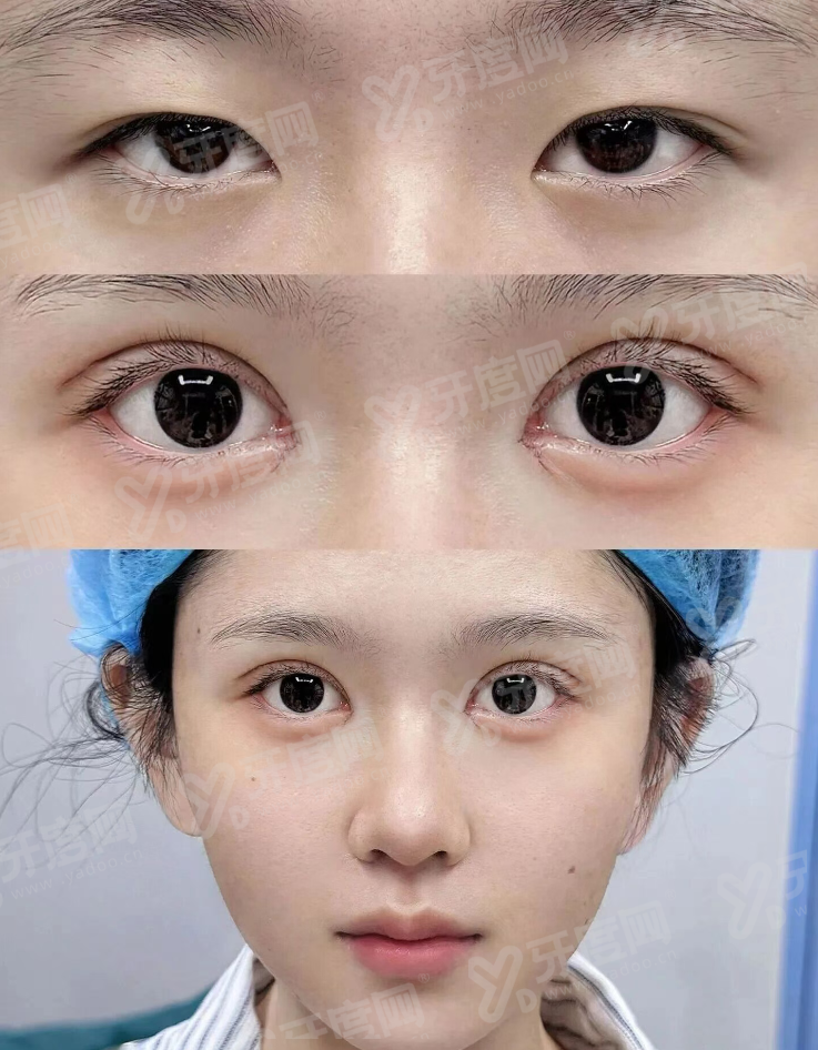 刘宾腹壁整形是免费预约吗？有但是不多，线上线下都可预约！