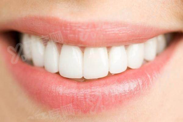 做了牙齿贴面里面牙会坏吗？可以避免！规范护理能防龋+树脂3-6年/瓷贴面8-10年