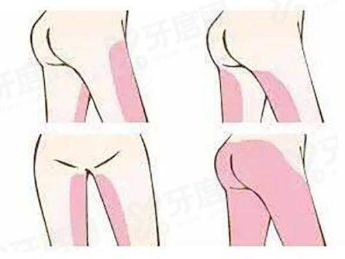 上海伊莱美朱迪割双眼皮多少钱？埋线3k+/三点定位5k+/全切8k+