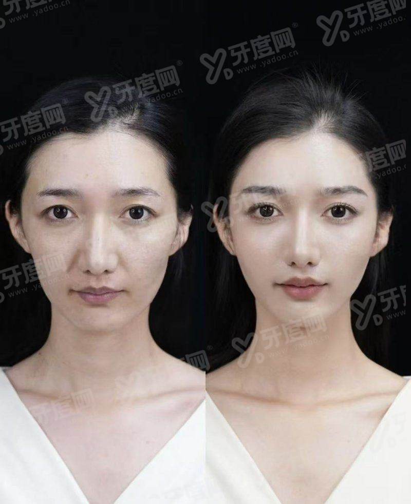 二、上海伊莱美朱迪割双眼皮怎么样yanke.yadoo.cn