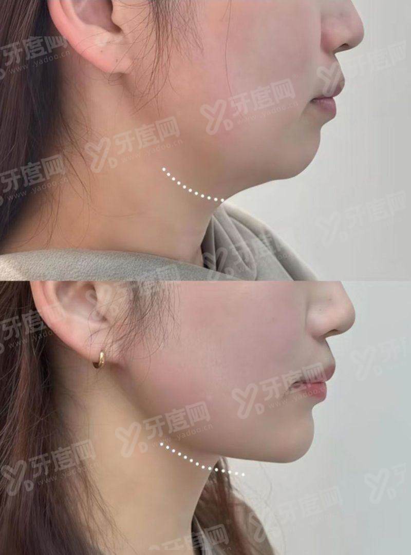 二、男性增粗增长手术有用吗yanke.yadoo.cn