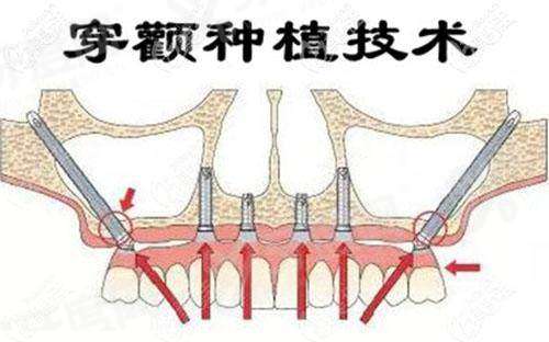 穿颧穿翼种植牙哪里能做？上海鼎植/北京中诺/广州广大/深圳格伦菲尔等口腔医院可靠