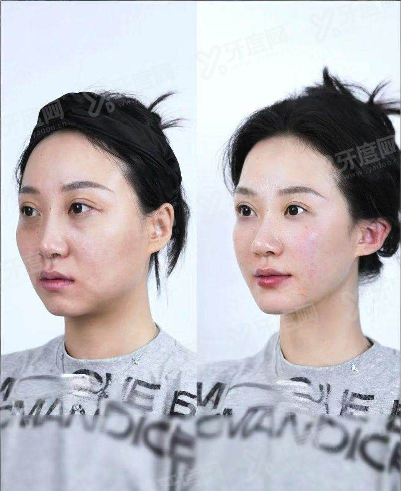 二、上海王洪医生取脸上填充物怎么样yanke.yadoo.cn