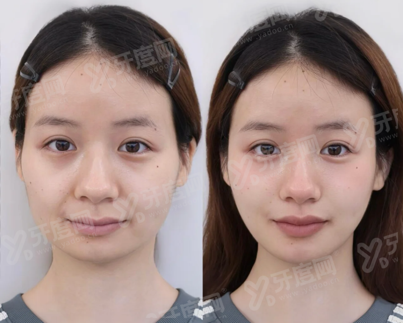 倒睫手术疤痕很明显怎么去除？局部/药物/手术治疗修复；不留疤及疤痕恢复时间揭秘