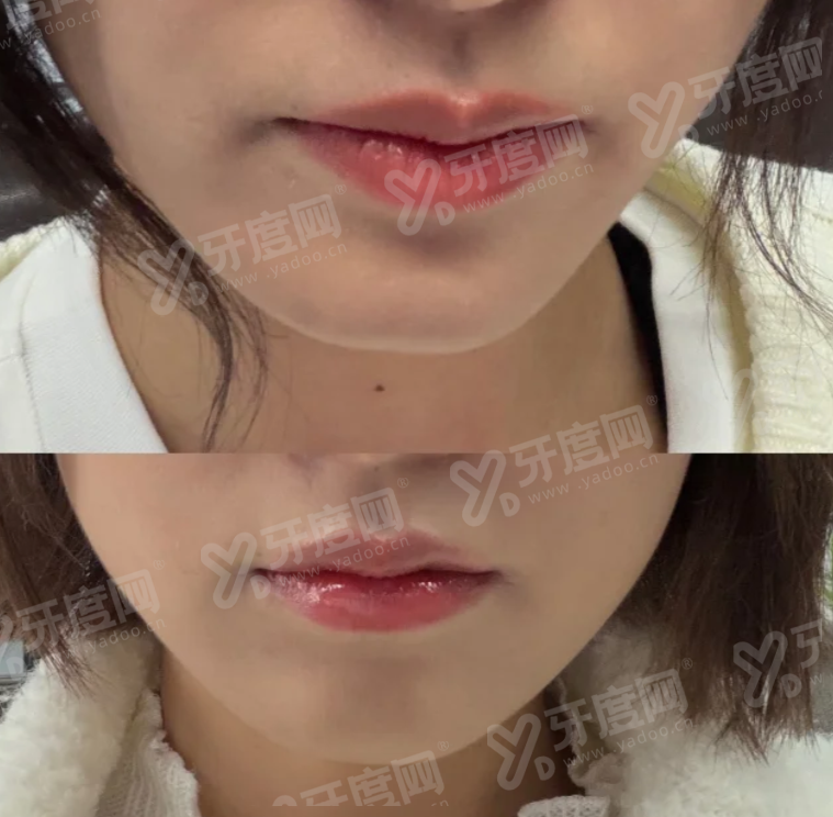 英伦大提升是什么医美项目？A型肉毒，成效好4800元起