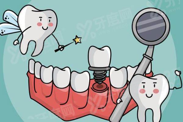 以色列亲水种植体是哪种？MIS/ADIN/Cortex各有亮点，能用15-20年，8000元起/颗 