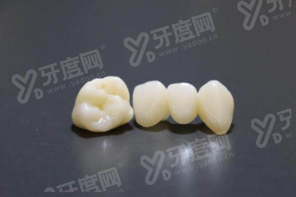 全瓷牙冠一颗500元贵吗？不靠谱！全瓷牙冠寿命一般5-20年，选对材料和机构不花冤枉钱！