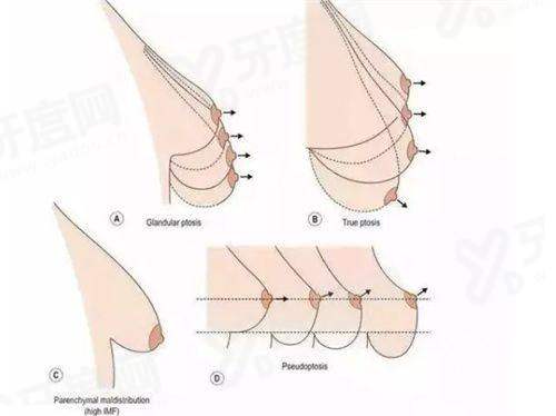 刘彦龙医生的注射增粗项目价格：脂肪胶8k/玻尿酸6k/胶原蛋白注射7.5k元起