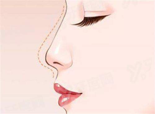 换人工耳蜗大概需要多少钱？国产7W+/进口10W+元起