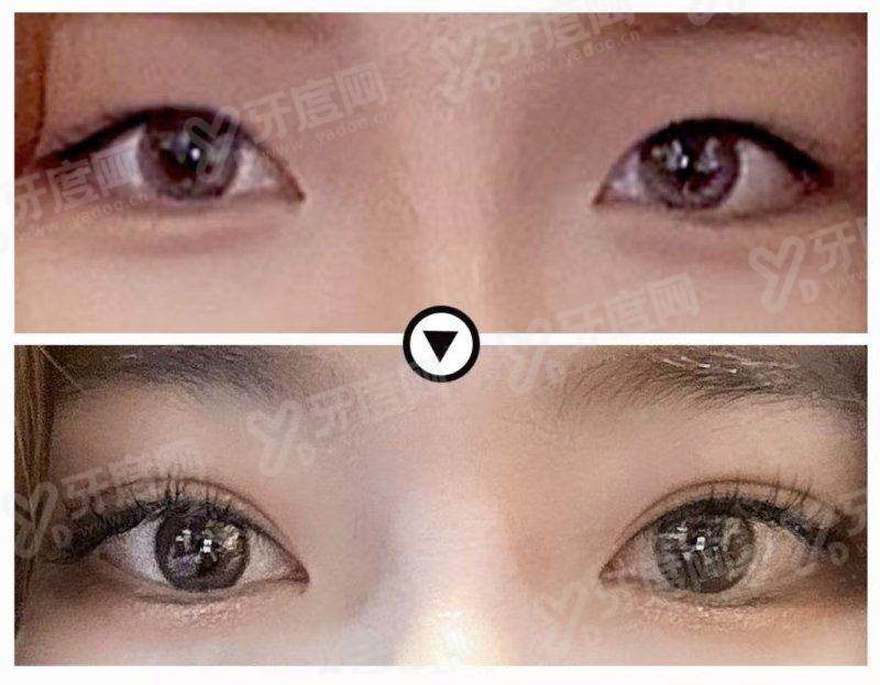 北京八大处郭鑫取异物多少钱？生长因子1W/脂肪填充取出1.5W元起