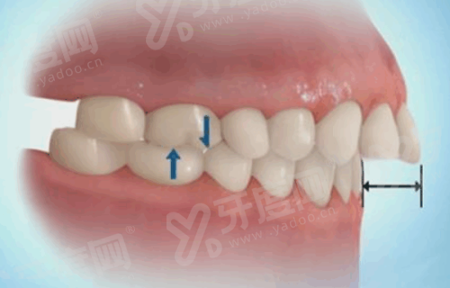 二、牙齿咬合重建价格表？（不同治疗方式价格差异参考）yanke.yadoo.cn