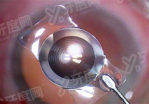 贵州人民医院眼科近视手术价格：普通激光6k/精雕C+全飞秒8k元起