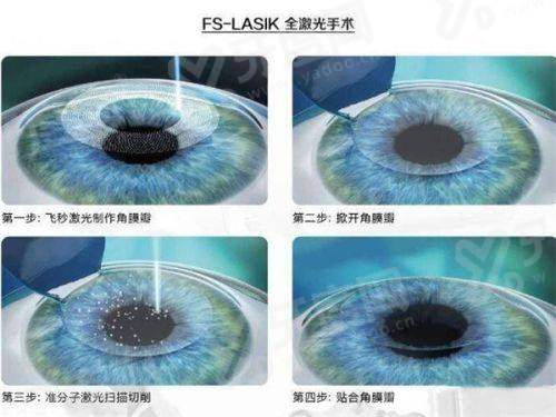 二、介绍贵阳康视眼科医院怎么样？（资质正规，医生专精，设备精良）yanke.yadoo.cn