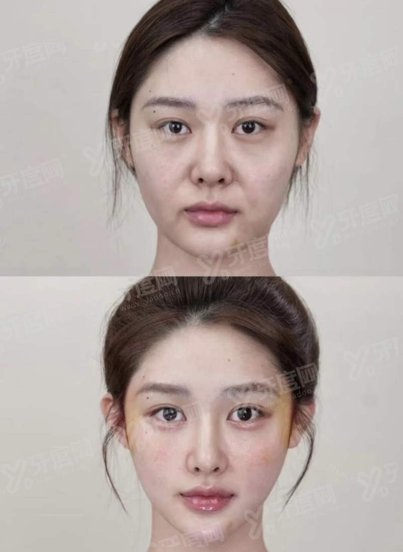 二、广西自体脂肪丰胸十大医院有哪些yanke.yadoo.cn