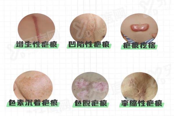 昆明昆大疤痕医院不坑人，收费标准曝光，费用明细公开