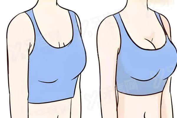 深圳徐英隆胸的口碑与评价怎么样？效果好、技术强，价格合理，这医生隆胸靠谱到爆！