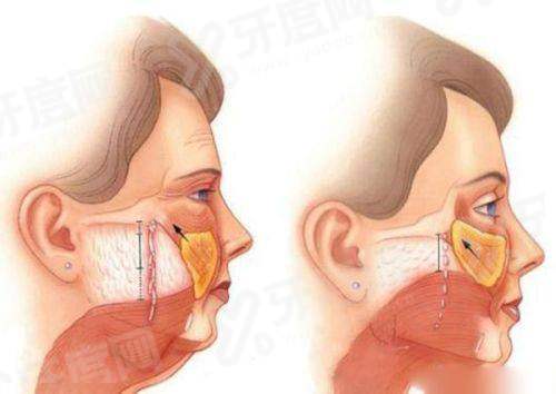 玻尿酸阴茎增大加粗靠谱吗？靠谱，维持2 - 3年但有副作用