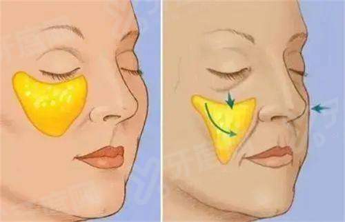 二、上海张贺医生缩小鼻翼怎么样yanke.yadoo.cn