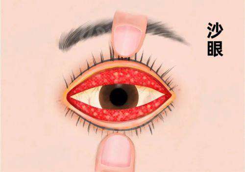 成都视网膜脱落手术费用表：巩膜外加压1W+/玻璃体切割2W+ 